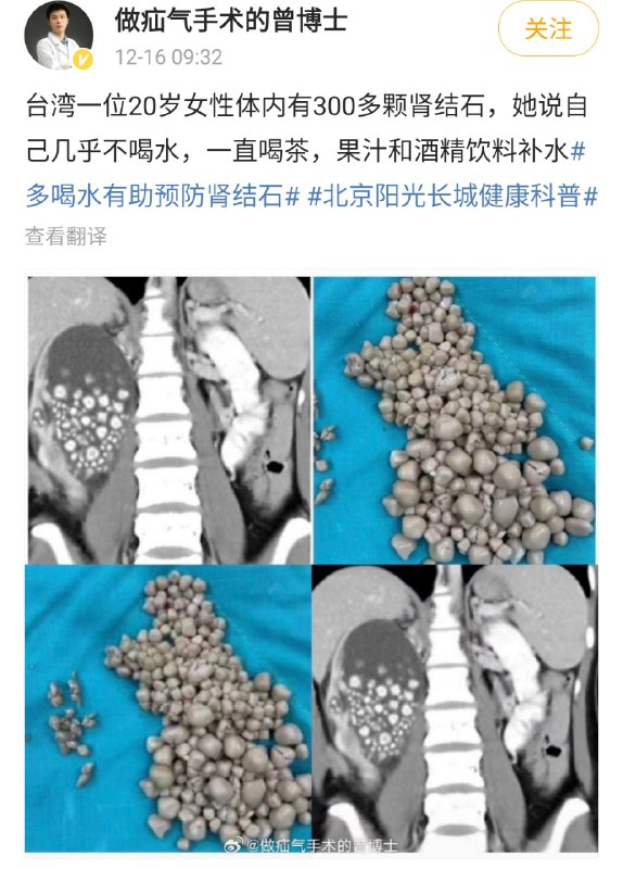 这么多肾结石，看着都疼啊